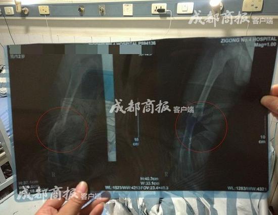 自贡老师教训未完成作业学生 致其摔倒骨折