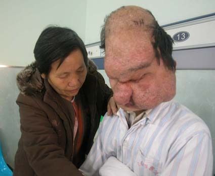 慎入!男子患怪病面部持续肿大似外星人 全球怪