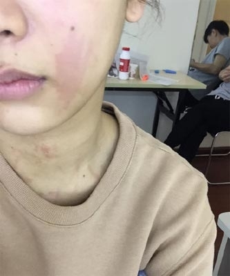 杨紫得荨麻疹面部红肿网友心疼 乐观自嘲天妒