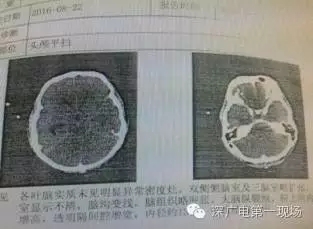 男子染食脑虫十几天后不治 提醒:避免到池塘