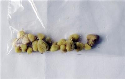 男子每天10瓶啤酒欲化掉肾结石 小心!这五种吃