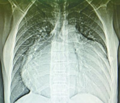 心脏大得像足球 医生妙手瘦身