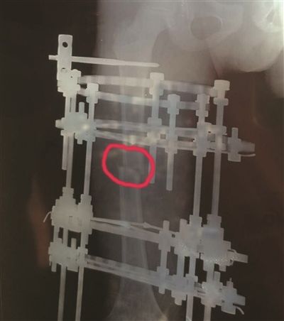 右腿比左腿短近6厘米 10岁娃断骨增高恢复正