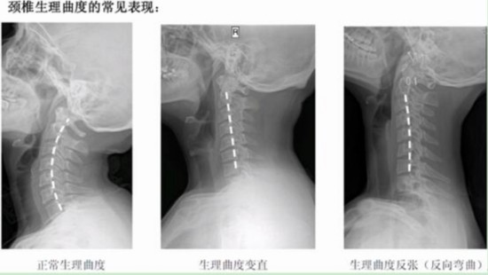 睡哪种枕头可以防颈椎病?