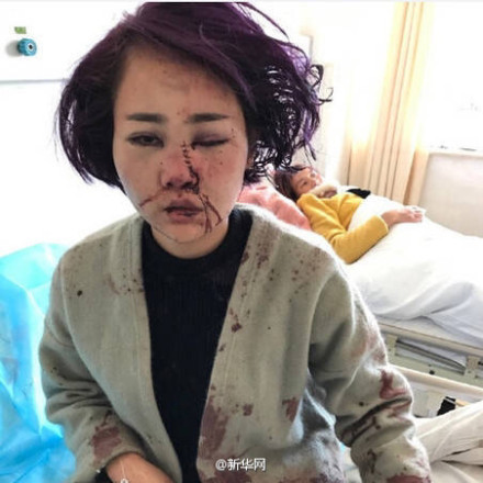 丽江遭打毁容女游客做伤情鉴 医生:容貌恢复难