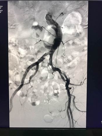 罕见!8旬老太双下肢动脉全部栓塞堵死 腿部冰