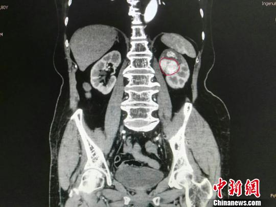 湖南八旬老妇见红 原来是肾癌作怪