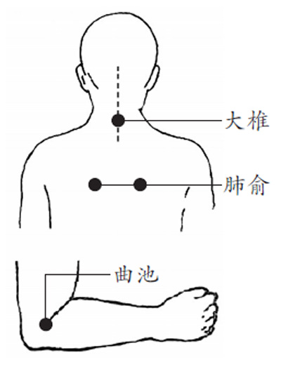 感冒发热,刮大椎、曲池