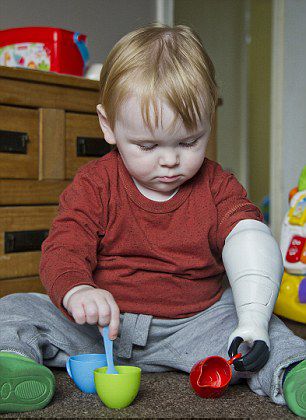 父爱如山!男童因病截肢父亲辞职为其造假肢