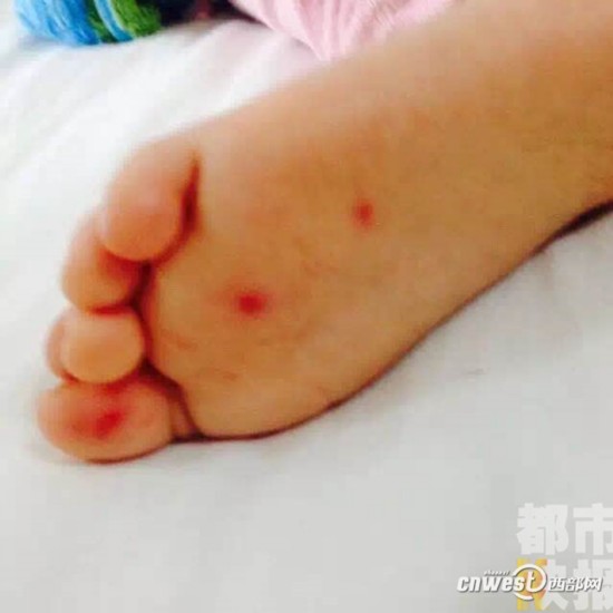 注意!孩子身上一出现小红点 可能传染手足口病--陕西频道--人民网