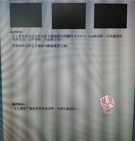 女子12年前注射丰胸 如今胸部掉到肚脐