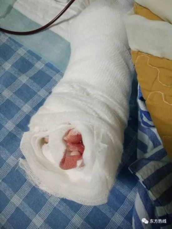 女婴被医生剪断指 不足1岁换纱布把指头换断了
