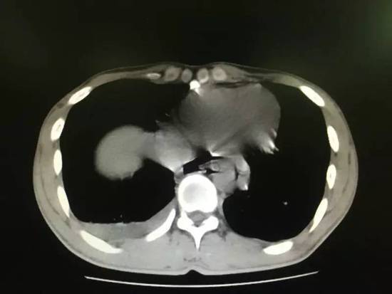 小伙聚餐喝二两白酒 吐得食道破裂伤口达8厘米