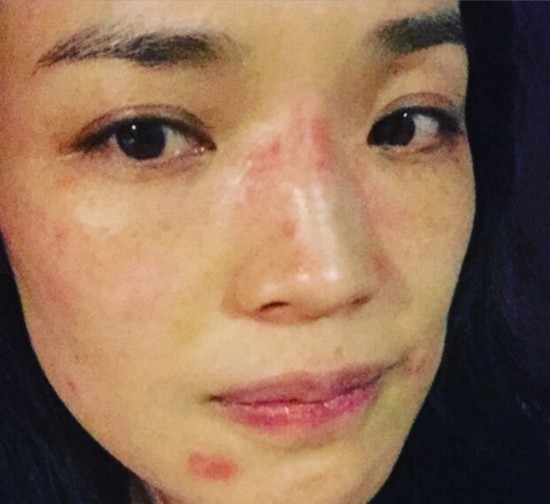 舒淇崩溃晒自拍照 脸部红肿过敏堪比毁容(组图