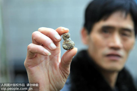 结石大小不同治疗方式各异 细说 肾结石的治疗方法