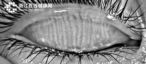 干眼症患者女性是男性的两倍 因为它专找"眼线女"
