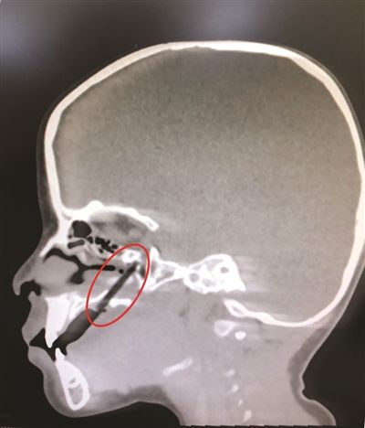 泰州男孩吃饭玩耍被半截筷子插入上颚