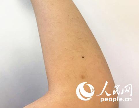 黑痣突然变大、隆起、出血?可能患有黑色素瘤