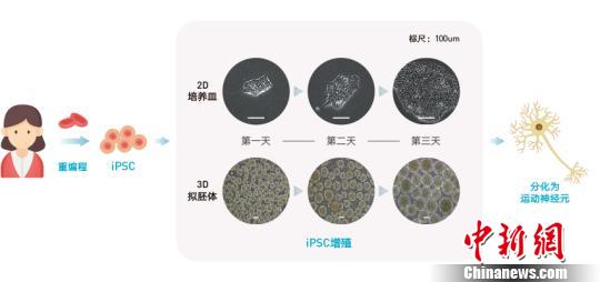 渐冻症人口_渐冻症图片