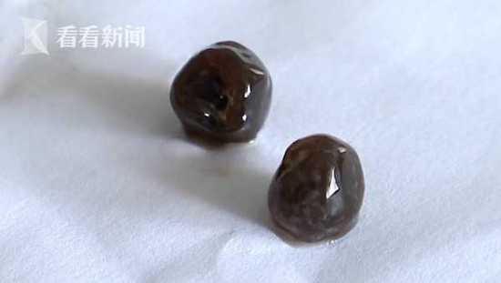 男孩贪杯珍珠奶茶致胆囊炎 胃部CT竟有40粒阴影