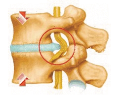 学会这四招防止腰椎间盘出轨