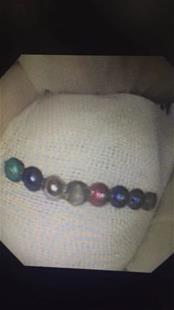 两岁宝宝误吞8颗磁力珠 专家提醒玩具安全隐患