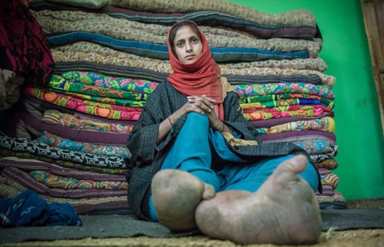 印度一女孩因患病脚丫异常肿胀从未穿鞋