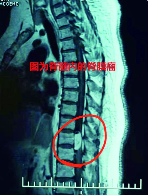腰间盘突出越治越严重? 男子腰疼不能走路原是长了脊膜瘤