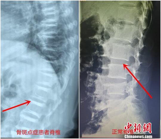 罕见“硬骨头”患者遇骨折 手术固定堪比在岩石上打洞 罕见“硬骨头”患者遇骨折 手术固定堪比在岩石上打洞