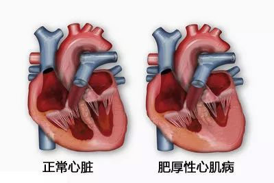 正常心脏和患肥厚性心肌病心脏的区别 中山大学孙逸仙纪念医院供