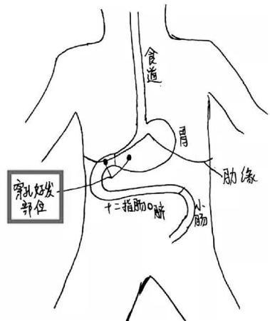 浙江一少年常年吃外卖，竟然吃到胃穿洞