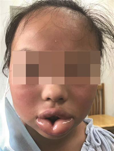 宜兴一名10岁女童吃了水蜜桃后,出现口唇肿胀,喉头水肿等严峻过敏反
