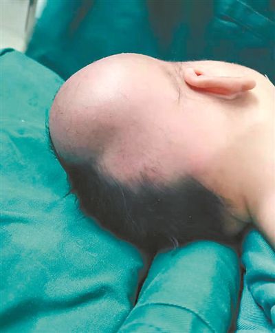 婴儿急产头部着地 出生5天勇闯5关