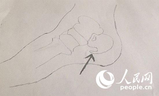 腿脚疼痛就买膏药治骨刺？别被不良商家误导了