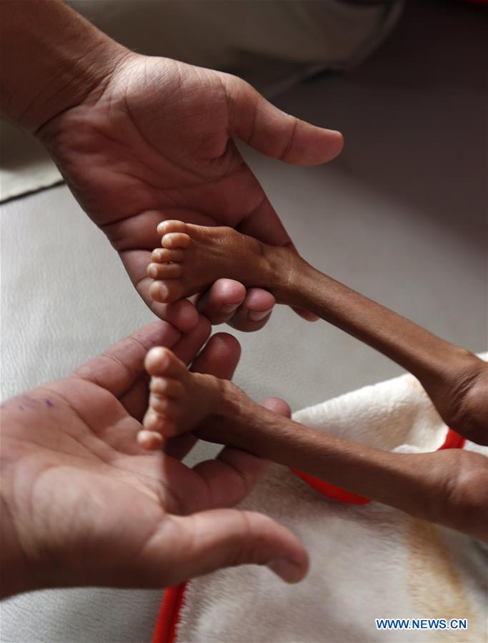 YEMEN-SANAA-CHILDREN-MALNUTRITION