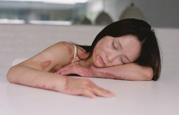 Disfigured victim posts glamor shots online