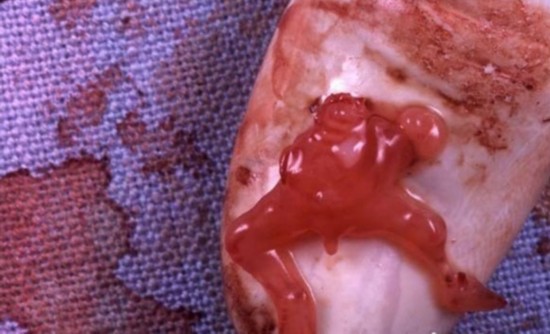 人工流产视频过程高清