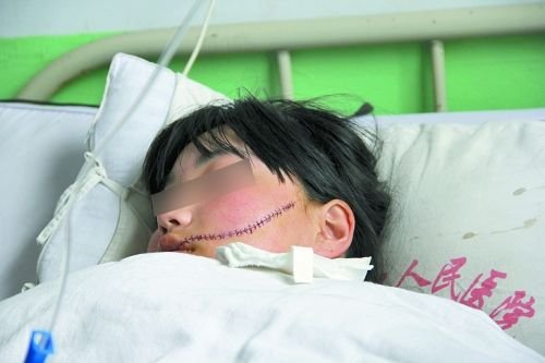 中学女生惨遭同学小刀毁容伤口长达13厘米图