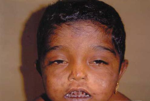 底里症  有奇怪的反射,这种病症的原有特性表现是,病人受到任何意想