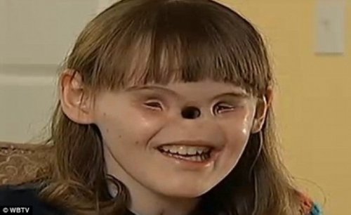 女孩患天生缺鼻子少眼揭全球罕见怪病图