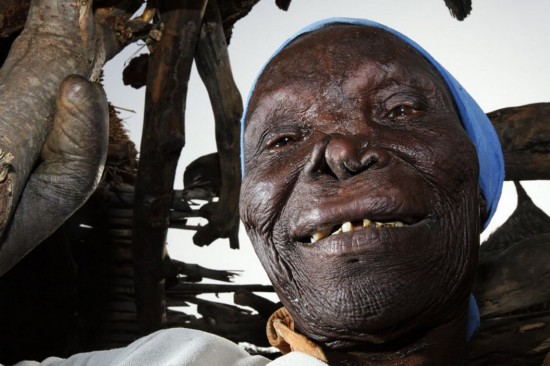 特殊人群!西非喀麦隆的麻风病患者【16】