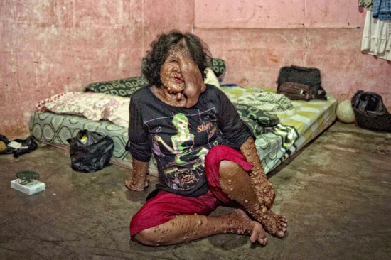 印尼泡泡皮肤女子被亲人抛弃 乞讨为生(图)【5】