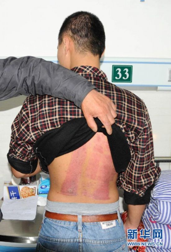 湖北南漳小伙三次割皮救父引社会关注(组图)