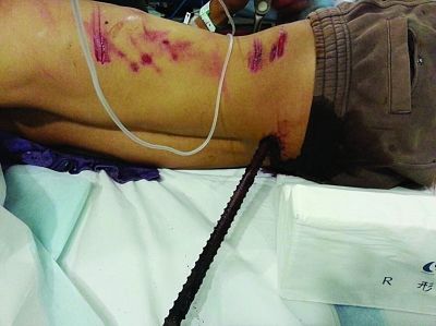 安徽男子坠楼两根钢筋刺穿身体 腰带救命 - yqh1955的日志 - 网易博客