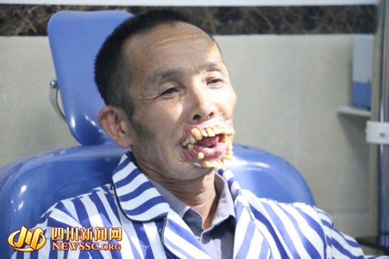54年前被狼咬成"无嘴人 贵州老人来四川"换脸"