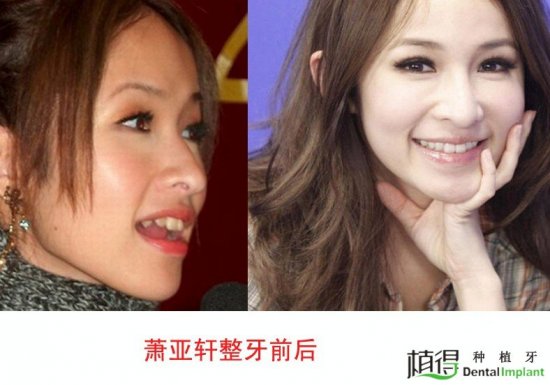 黑涉会mm里的筱婕,也曾是一位牙套妹,戴着牙套的她笑起来都很不