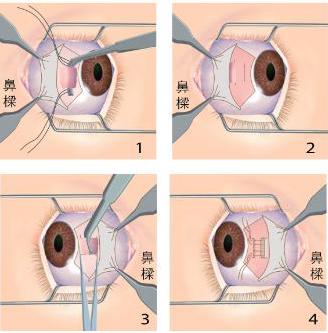 斗鸡眼手术图片