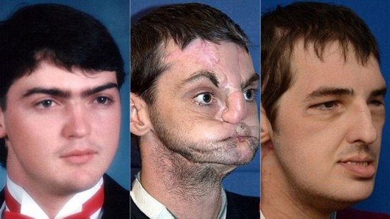 39岁的美国换脸男子理查德·诺里斯首次见到脸部捐献者约苏亚的家人们