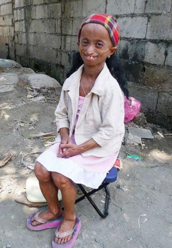 菲花季少女患早衰症身体年龄达144岁(高清组图)