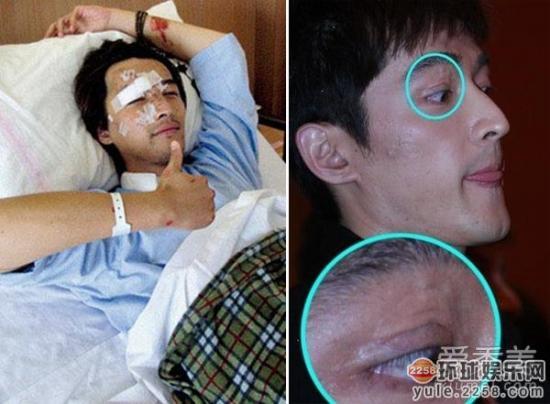 黄晓明面部血管爆裂 盘点意外受伤遭毁容的明星
